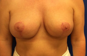 Breast Lift Case 7141 After Photo Breast Lift
