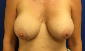 Breast Revision Case 7171 Before Photo Breast Revision