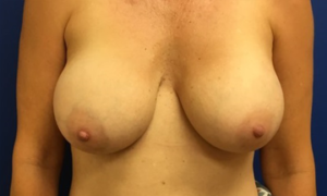 Breast Revision