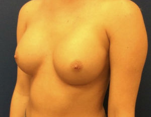 Silicone Breast Augmentation