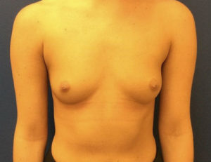 Silicone Breast Augmentation Case 7233 Before Photo Silicone Breast Augmentation
