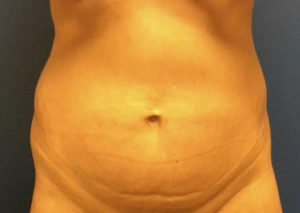 Tummy Tuck