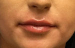 Dermal Filler