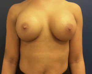 Silicone Breast Augmentation