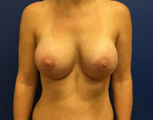 Breast Enhancement (Breast Lift with Implants) Case 7514 After Photo Breast Enhancement (Breast Lift with Implants)