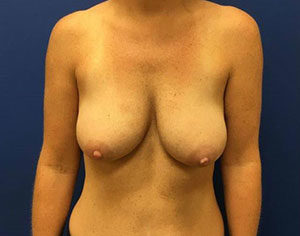 Breast Enhancement (Breast Lift with Implants) Case 7514 Before Photo Breast Enhancement (Breast Lift with Implants)
