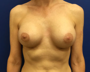 Silicone Breast Augmentation