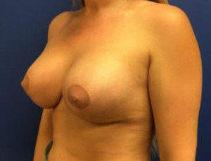 Breast Enhancement (Breast Lift with Implants) Case 7552 After Photo Breast Enhancement (Breast Lift with Implants)