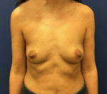 Saline Breast Augmentation