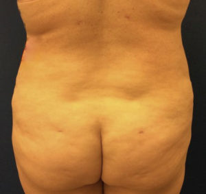 Liposuction