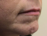 Dermal Filler