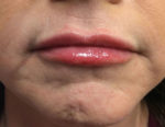 Dermal Filler