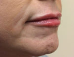 Dermal Filler