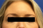 Dermal Filler