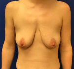 Breast Enhancement (Breast Lift with Implants)