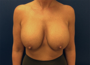 Breast Implant Removal with Breast Lift
