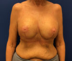 Breast Enhancement (Breast Lift with Implants)