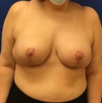 Breast Reduction