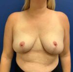 Breast Reduction