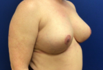 Breast Implant Removal with Breast Lift