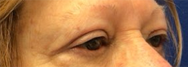 Blepharoplasty