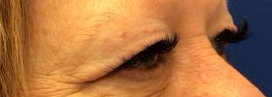 Blepharoplasty