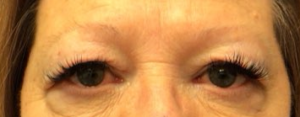 Blepharoplasty