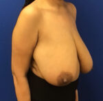 Breast Reduction