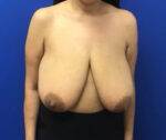 Breast Reduction