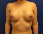 Breast Enhancement (Breast Lift with Implants)