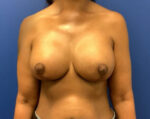 Breast Revision