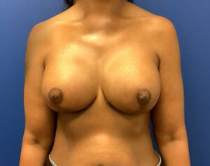 Breast Revision Case 11354 After Photo Breast Revision