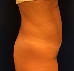 Tummy Tuck Case 14855 After Photo Tummy Tuck
