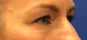 Blepharoplasty