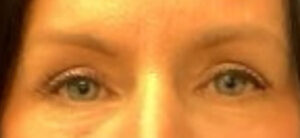 Blepharoplasty