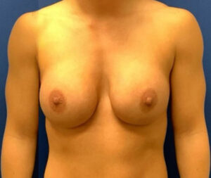 Silicone Breast Augmentation