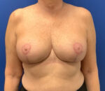 Breast Reduction