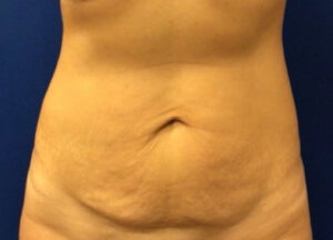 Tummy Tuck