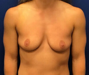 Silicone Breast Augmentation