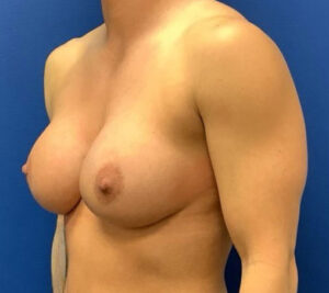Silicone Breast Augmentation