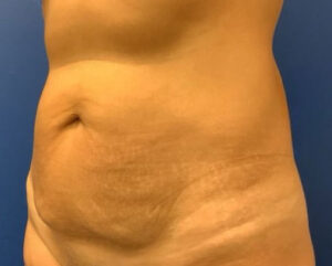 Tummy Tuck