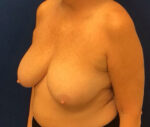 Breast Reduction
