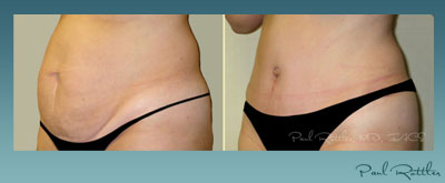 34-Year Old Abdominoplasty Patient Photo, Tummy Tuck St. Louis - Paul Rottler, MD, FACS