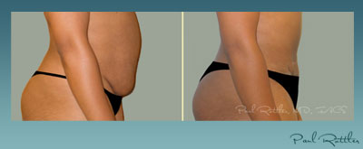 Before And After Side View Photos Of Tummy Tuck, St. Louis - Paul Rottler, MD, FACS