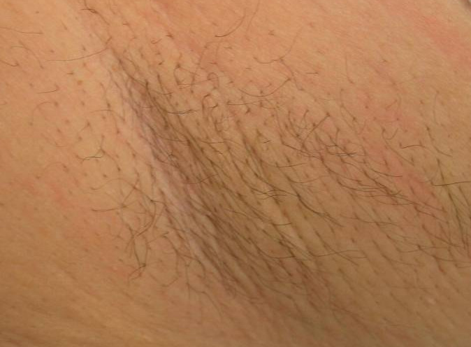 Laser Hair Removal St Louis