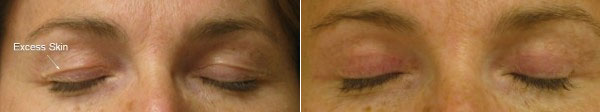 Before & After Blepharoplasty Photos
