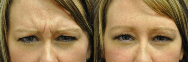 Botox Injection Results St. Louis