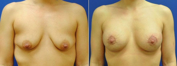 Before & After Breast Enhancement Photos