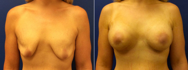Before & After Breast Enhancement Photos