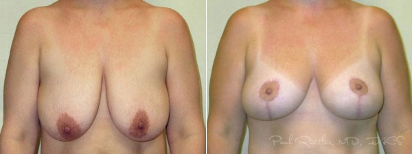 Before & After Breast Lift Photos